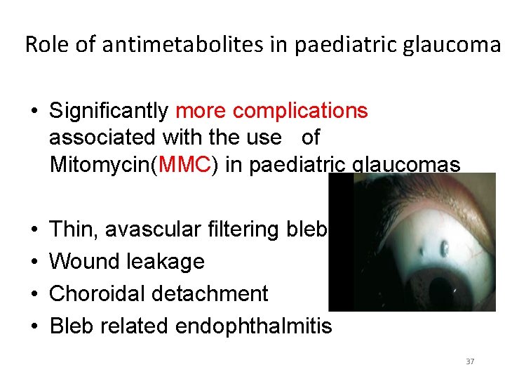 Role of antimetabolites in paediatric glaucoma • Significantly more complications associated with the use