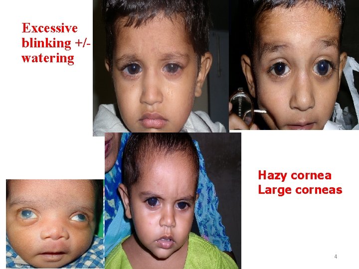 Excessive blinking +/watering Hazy cornea Large corneas 4 