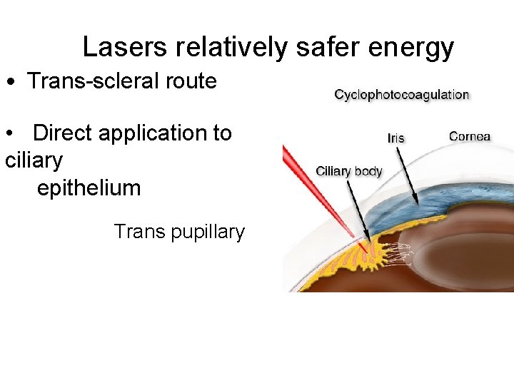 Lasers relatively safer energy • Trans-scleral route • Direct application to ciliary epithelium Trans