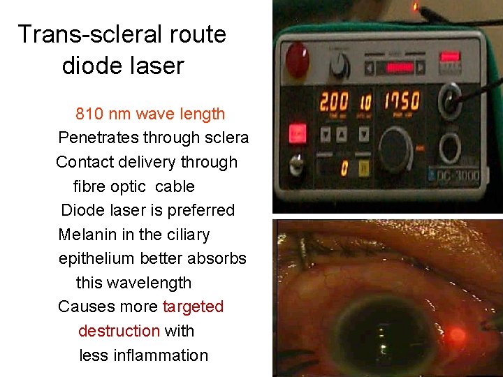 Trans-scleral route diode laser 810 nm wave length Penetrates through sclera Contact delivery through