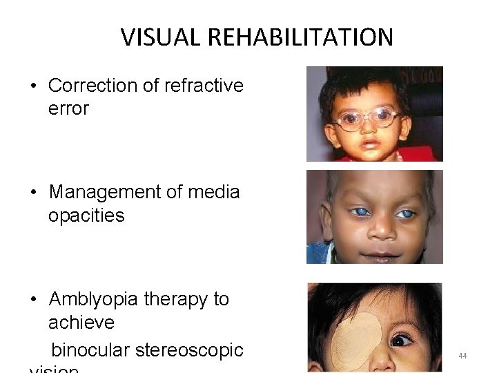 VISUAL REHABILITATION • Correction of refractive error • Management of media opacities • Amblyopia