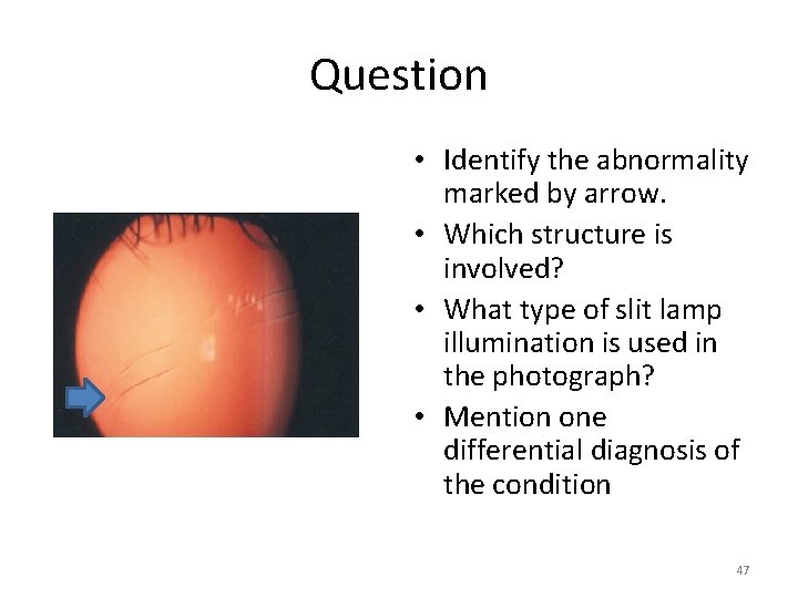 Question • Identify the abnormality marked by arrow. • Which structure is involved? •