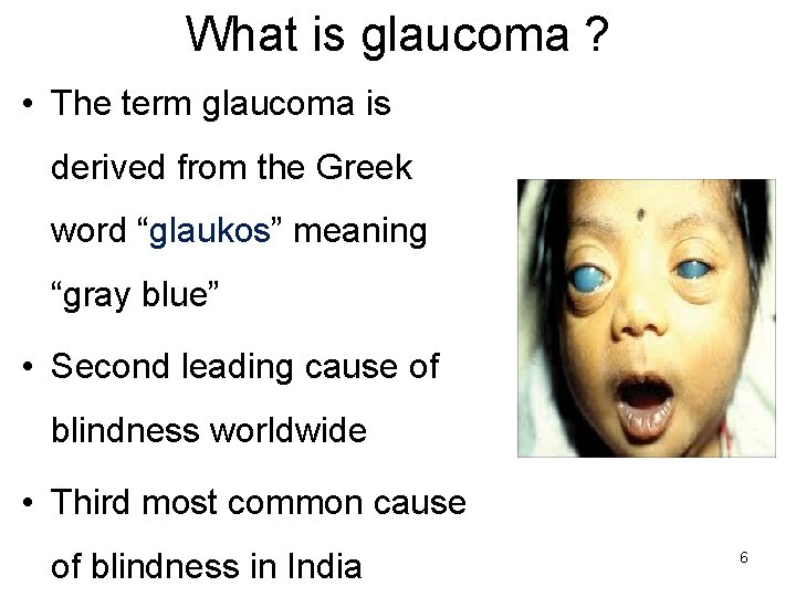 What is glaucoma ? • The term glaucoma is derived from the Greek word