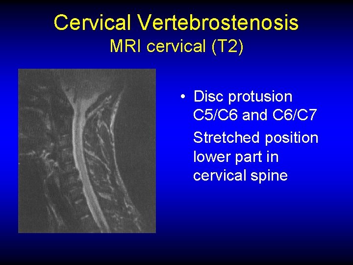 Cervical Vertebrostenosis MRI cervical (T 2) • Disc protusion C 5/C 6 and C