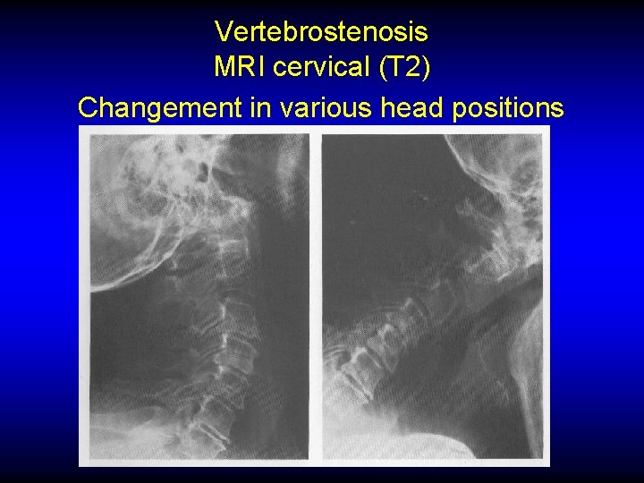 Vertebrostenosis MRI cervical (T 2) Changement in various head positions 