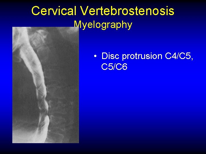 Cervical Vertebrostenosis Myelography • Disc protrusion C 4/C 5, C 5/C 6 