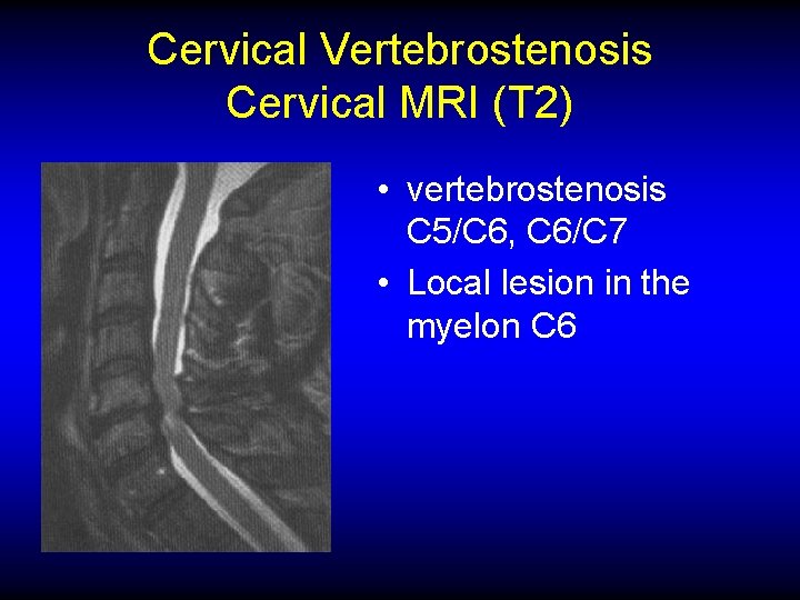 Cervical Vertebrostenosis Cervical MRI (T 2) • vertebrostenosis C 5/C 6, C 6/C 7