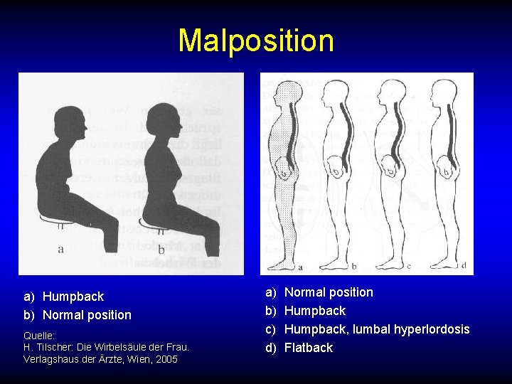 Malposition a) Humpback b) Normal position Quelle: H. Tilscher: Die Wirbelsäule der Frau. Verlagshaus