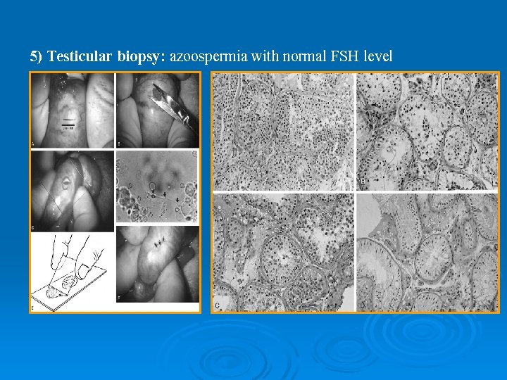  5) Testicular biopsy: azoospermia with normal FSH level 