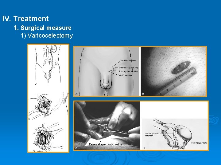 IV. Treatment 1. Surgical measure 1) Varicocelectomy 