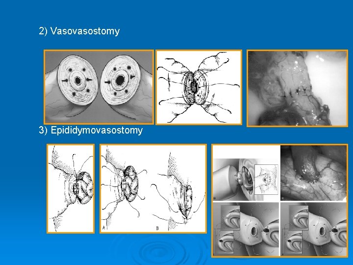  2) Vasovasostomy 3) Epididymovasostomy 