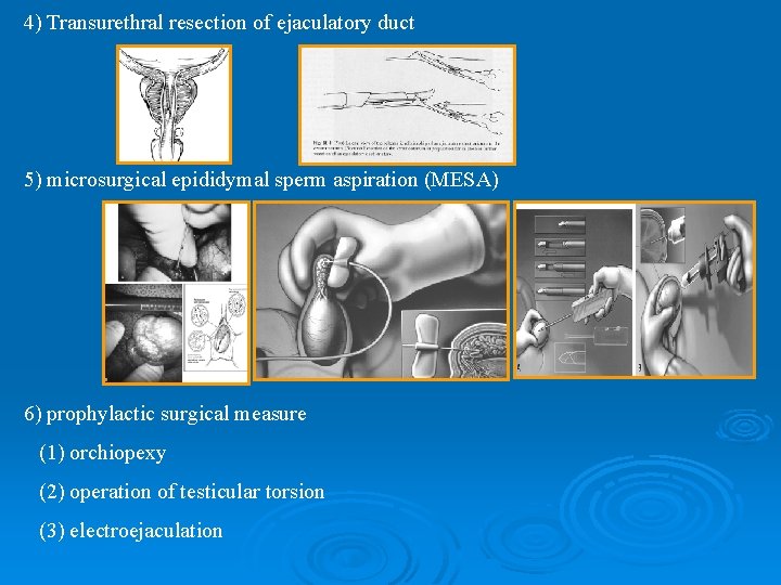 4) Transurethral resection of ejaculatory duct 5) microsurgical epididymal sperm aspiration (MESA) 6) prophylactic