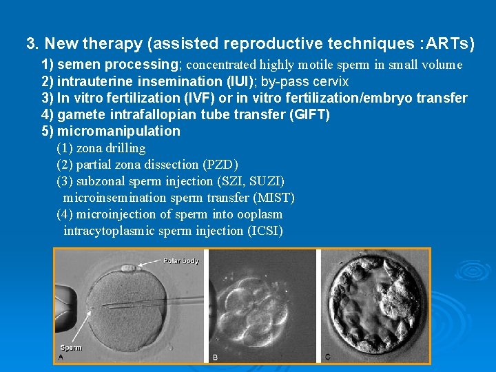 3. New therapy (assisted reproductive techniques : ARTs) 1) semen processing; concentrated highly motile