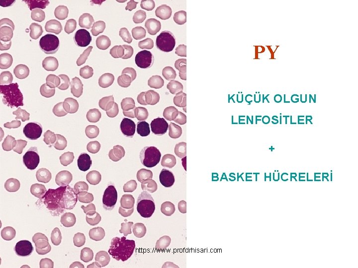 PY KÜÇÜK OLGUN LENFOSİTLER + BASKET HÜCRELERİ https: //www. profdrhisari. com 