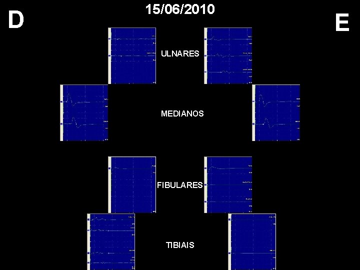 D 15/06/2010 ULNARES MEDIANOS FIBULARES TIBIAIS E 