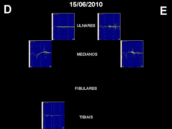 D 15/06/2010 ULNARES MEDIANOS FIBULARES TIBIAIS E 