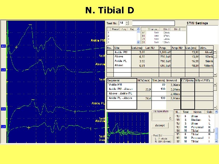 N. Tibial D 