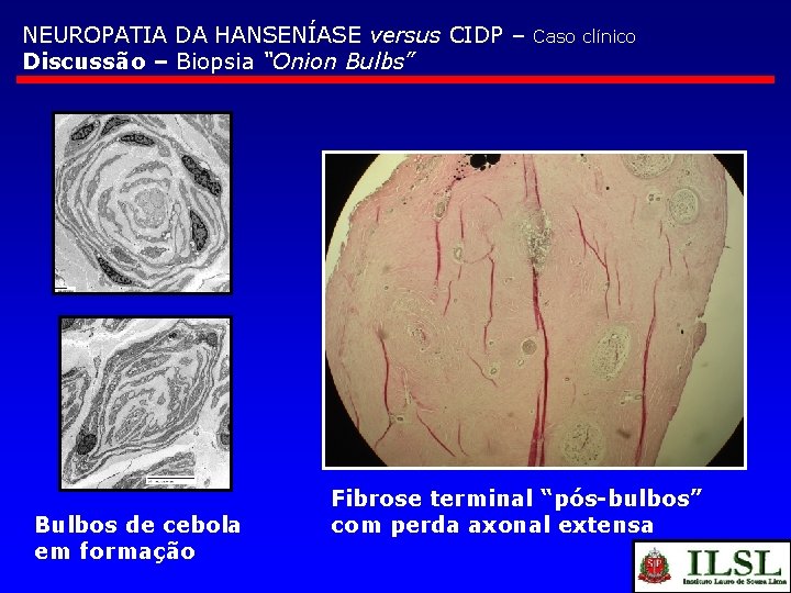 NEUROPATIA DA HANSENÍASE versus CIDP – Discussão – Biopsia “Onion Bulbs” Bulbos de cebola