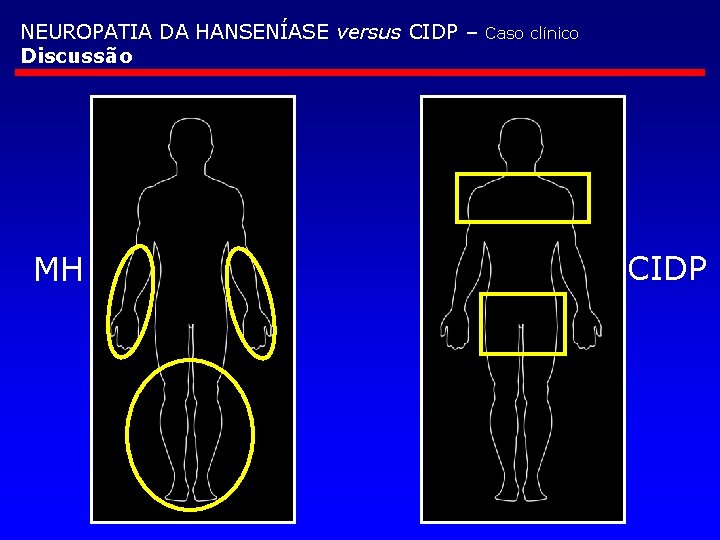 NEUROPATIA DA HANSENÍASE versus CIDP – Discussão MH Caso clínico CIDP 