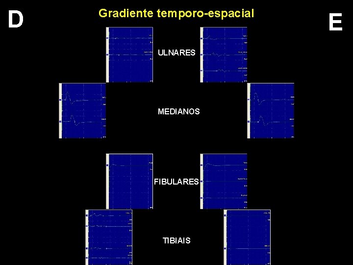 D Gradiente temporo-espacial ULNARES MEDIANOS FIBULARES TIBIAIS E 
