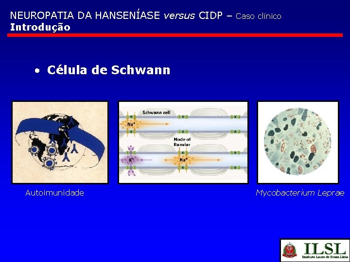 NEUROPATIA DA HANSENÍASE versus CIDP – Introdução Caso clínico • Célula de Schwann Autoimunidade