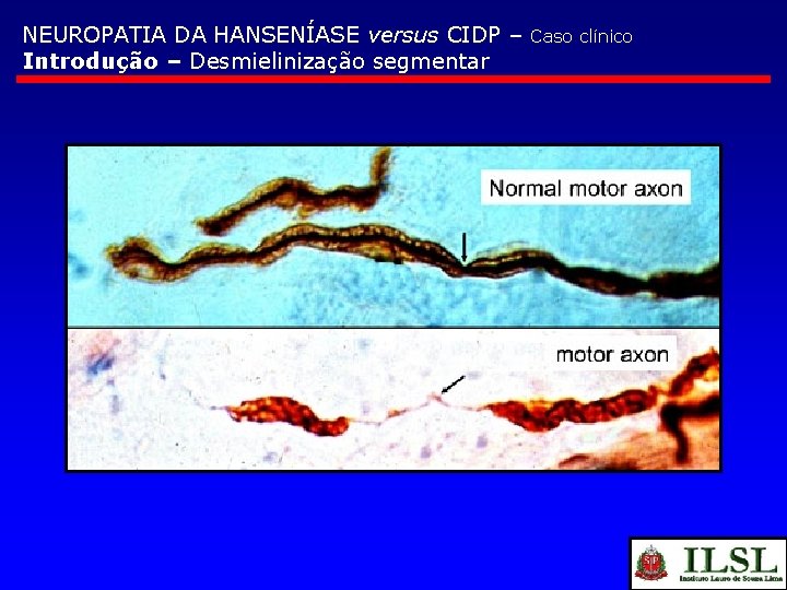 NEUROPATIA DA HANSENÍASE versus CIDP – Introdução – Desmielinização segmentar Caso clínico 
