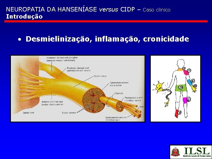 NEUROPATIA DA HANSENÍASE versus CIDP – Introdução Caso clínico • Desmielinização, inflamação, cronicidade 