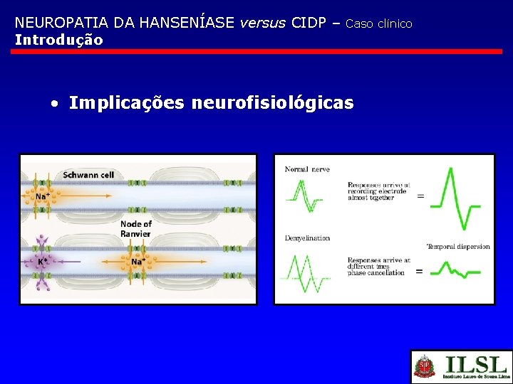 NEUROPATIA DA HANSENÍASE versus CIDP – Introdução Caso clínico • Implicações neurofisiológicas 