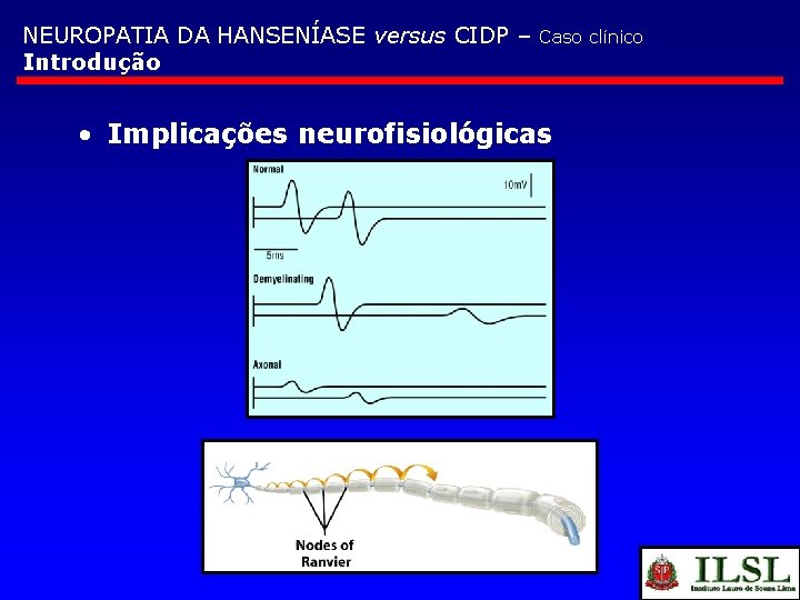 NEUROPATIA DA HANSENÍASE versus CIDP – Introdução Caso clínico • Implicações neurofisiológicas 