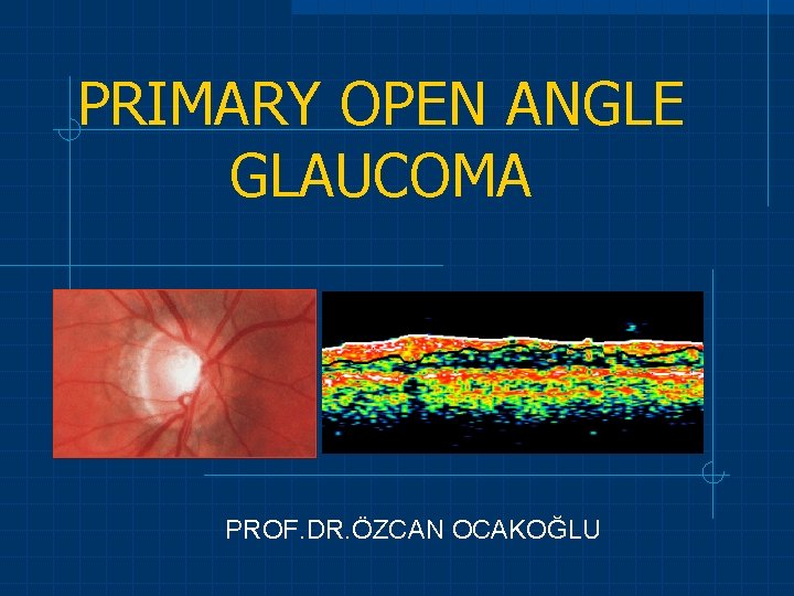 PRIMARY OPEN ANGLE GLAUCOMA PROF. DR. ÖZCAN OCAKOĞLU 