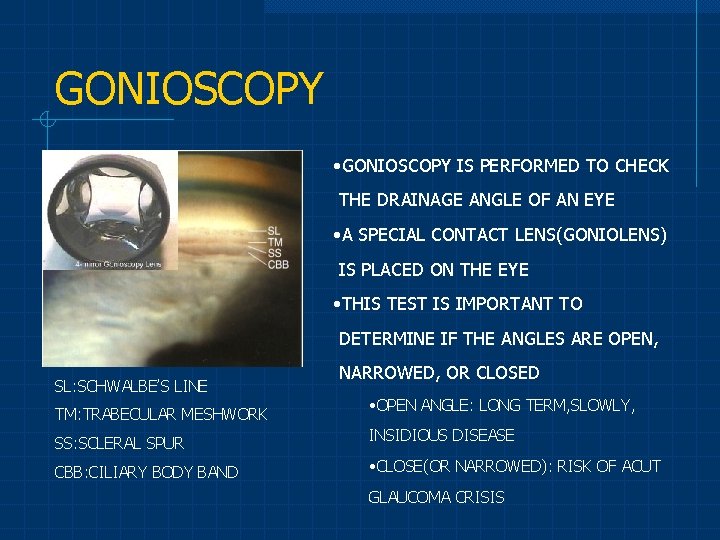 GONIOSCOPY • GONIOSCOPY IS PERFORMED TO CHECK THE DRAINAGE ANGLE OF AN EYE •