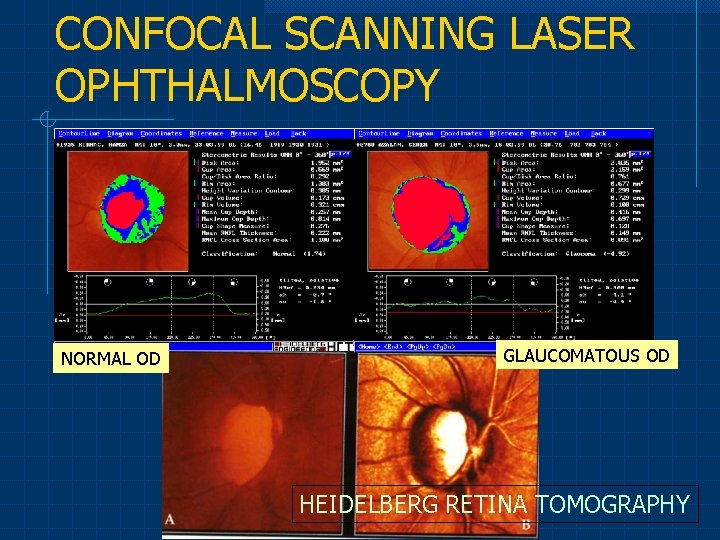 CONFOCAL SCANNING LASER OPHTHALMOSCOPY NORMAL OD GLAUCOMATOUS OD HEIDELBERG RETINA TOMOGRAPHY 