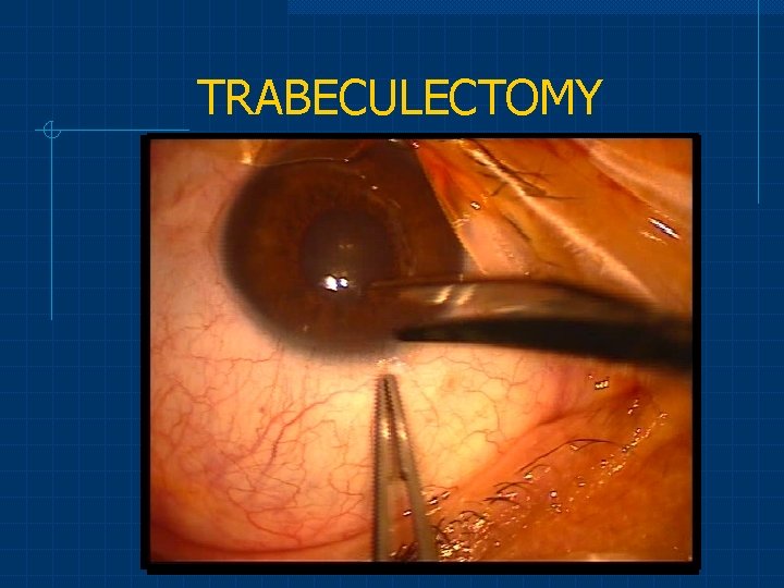 TRABECULECTOMY 