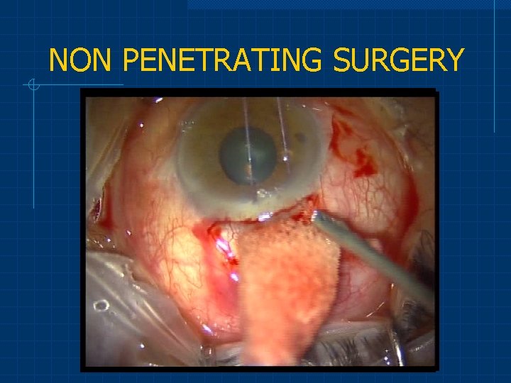 NON PENETRATING SURGERY 