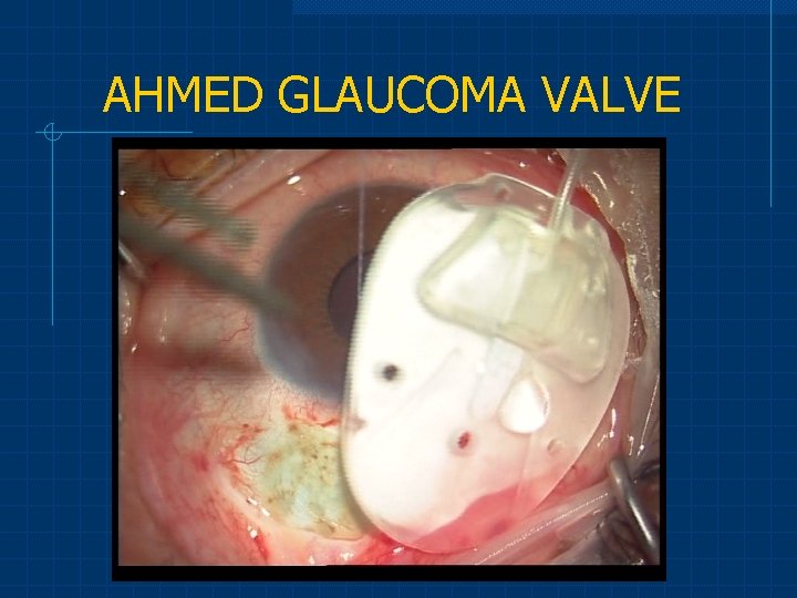 AHMED GLAUCOMA VALVE 