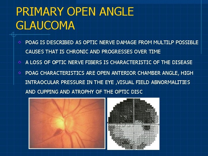 PRIMARY OPEN ANGLE GLAUCOMA POAG IS DESCRIBED AS OPTIC NERVE DAMAGE FROM MULTILP POSSIBLE