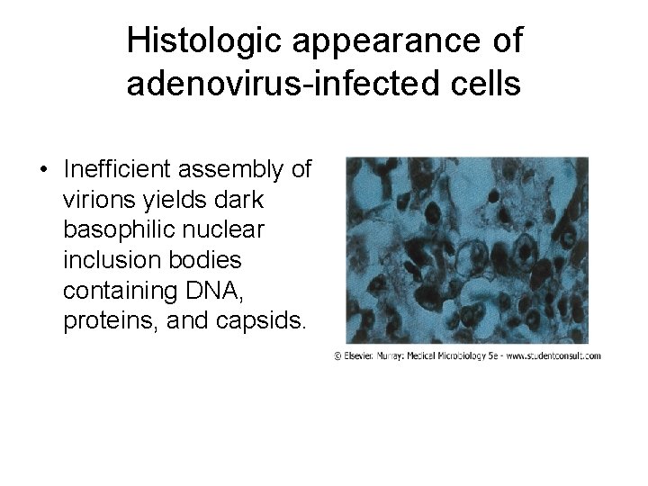 Histologic appearance of adenovirus-infected cells • Inefficient assembly of virions yields dark basophilic nuclear