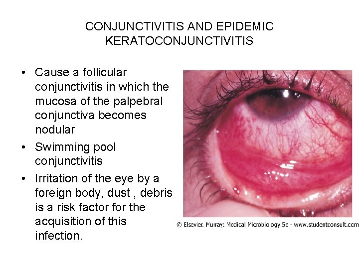 CONJUNCTIVITIS AND EPIDEMIC KERATOCONJUNCTIVITIS • Cause a follicular conjunctivitis in which the mucosa of