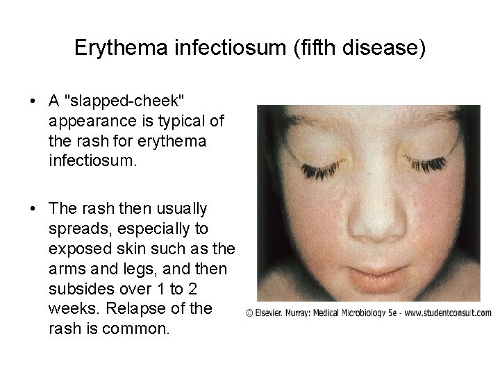 Erythema infectiosum (fifth disease) • A "slapped-cheek" appearance is typical of the rash for