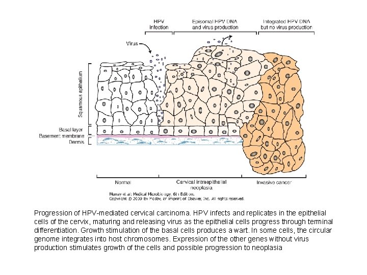 Progression of HPV-mediated cervical carcinoma. HPV infects and replicates in the epithelial cells of