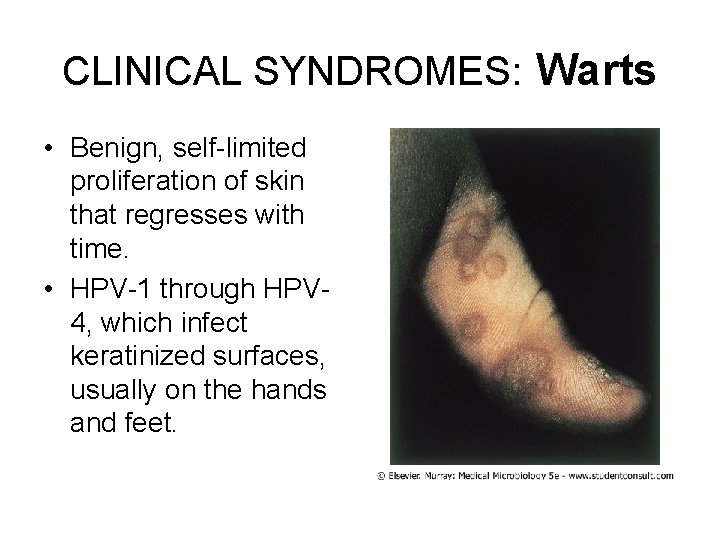 CLINICAL SYNDROMES: Warts • Benign, self-limited proliferation of skin that regresses with time. •
