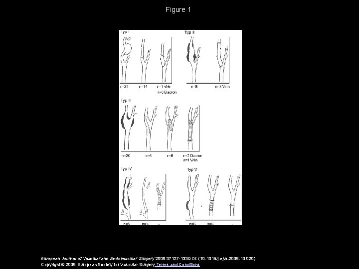 Figure 1 European Journal of Vascular and Endovascular Surgery 2009 37127 -133 DOI: (10.