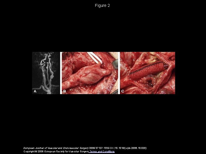 Figure 2 European Journal of Vascular and Endovascular Surgery 2009 37127 -133 DOI: (10.