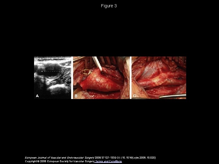 Figure 3 European Journal of Vascular and Endovascular Surgery 2009 37127 -133 DOI: (10.