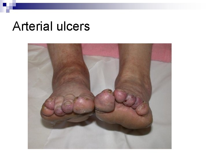 Arterial ulcers Arterial ulcers