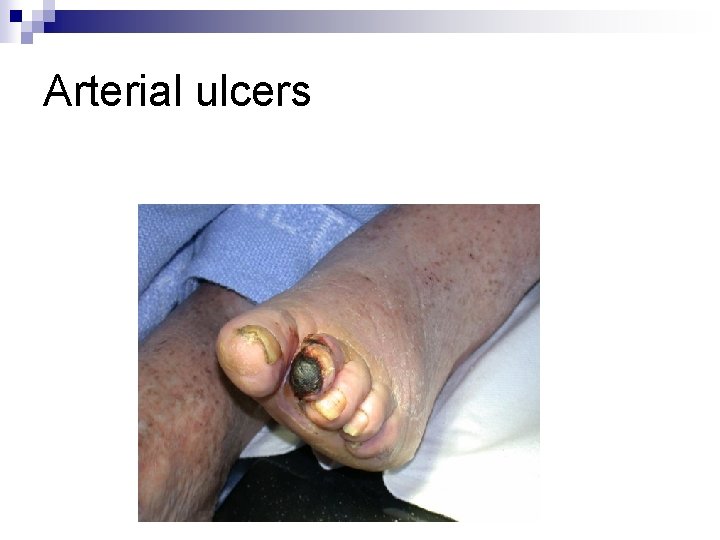 Arterial ulcers Arterial ulcers