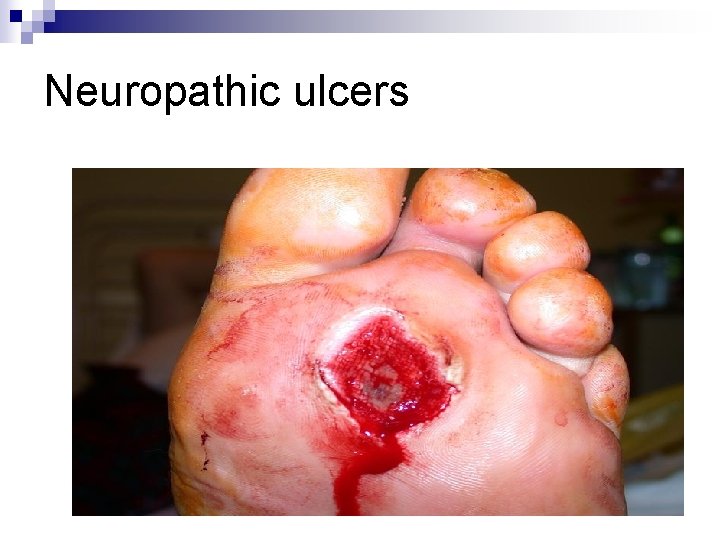 Neuropathic ulcers Neuropathic ulcers