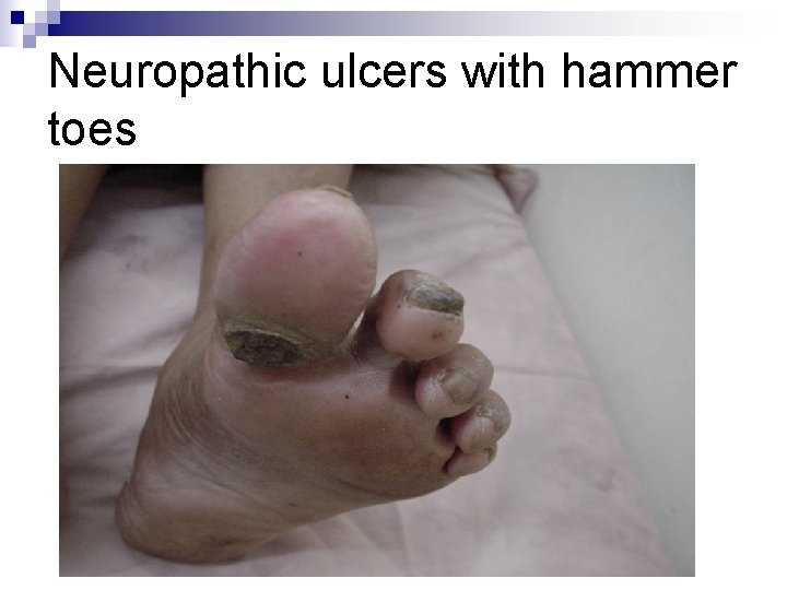 Neuropathic ulcers with hammer toes 