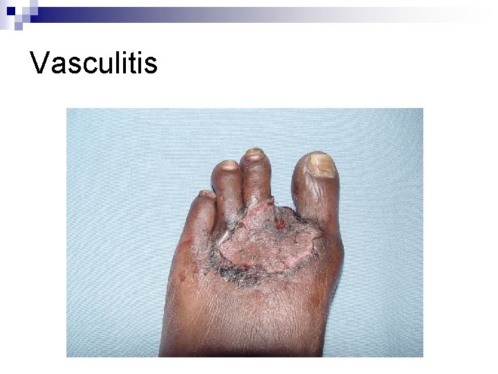 Vasculitis Vasculitis