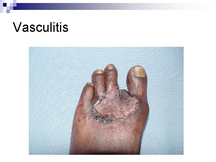 Vasculitis 